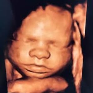 Picture Perfect Ultrasound - Ultrasound Package A (2D-3D-4D Elective Ultrasound Package Value $250